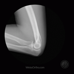 Elbow in motion x-ray