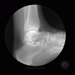 Ankle in motion x-ray