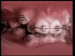 how braces work to fix teeth …..beautiful ﻿