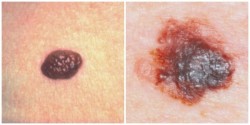 She Thought It Was Just A Normal Mole — Until She Saw THIS. Now? I’m Checking My Skin Too!