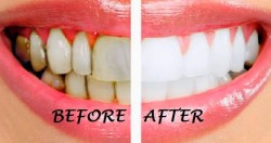 The Best Natural Teeth Whitening Technique That Can Transform Your Health, Recommended By Doctors