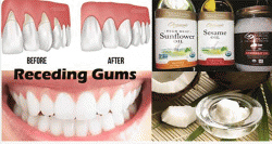 Gum Disease: The Silent Killer, 7 Home Remedies To Cure It Naturally