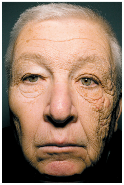 Sun damage after 28 years of driving a delivery truck