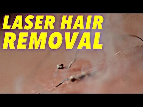 Science of Laser Hair Removal in SLOW MOTION – YouTube