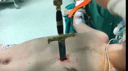 Surgeon removes sword from beside man’s beating heart (GRAPHIC VIDEO) — RT Viral