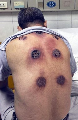 Popular treatment known as ‘cupping therapy’ leaves man with seven holes in his back