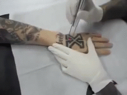 Laser Tattoo Removal﻿