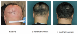 Alopecia Areata: Researchers Test the First-Ever Effective Treatment for Baldness