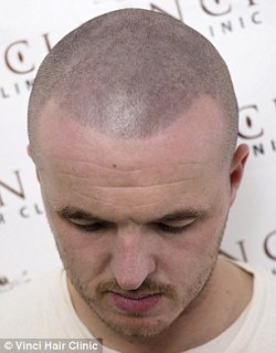 Bald men turn to hair tattoos to creates the illusion of short hair | Daily Mail Online
