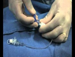 IVC Filter removal – Youtube