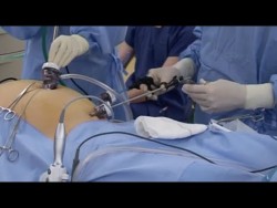 Laparoscopic Right Hemicolectomy – YouTube