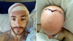 Man whose skull was fractured in fox hunt brawl speaks out | Metro News