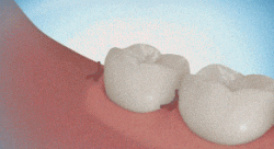 How wisdom teeth are extracted