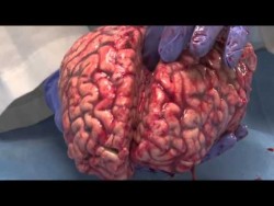 The Unfixed Brain – YouTube