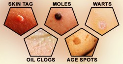 How To Easily Remove Skin Tags, Moles, Blackheads, Spots And Warts By Using Natural Remedies