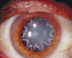 The eye injury of an electrician following a shock of 14,000 volts.