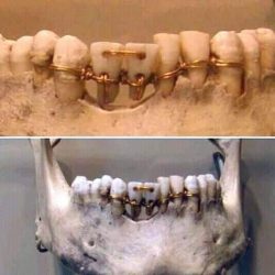 Dental work found on a 4,000- year old mummy in ancient Egypt