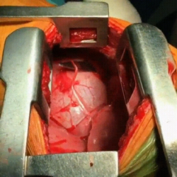 Open heart surgery showing the removal of a HUGE blade chest. It’s so close it’s pie ...