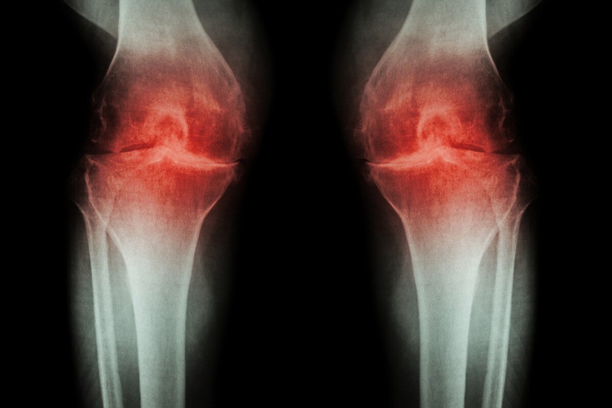 Researchers have investigated the role a particular signaling pathway plays in osteoarthritis pain