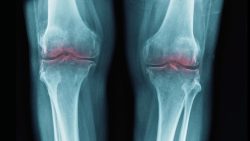 Stanford finds the switch for joint aging: an injection could prevent millions of knee replaceme ...